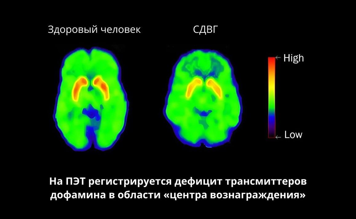 Синдром рассеянного внимания