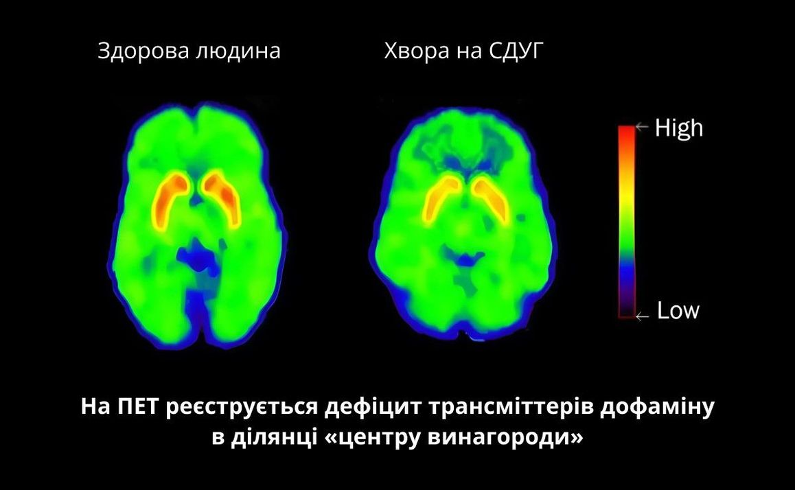 Синдром розсіяної уваги